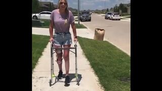 Pretty Lady in a Leg Brace